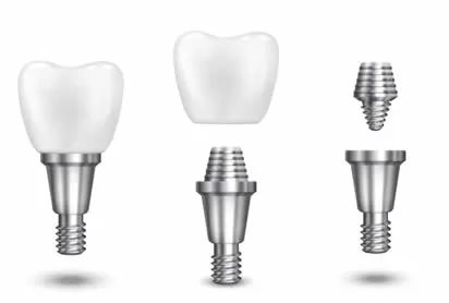 dental implant