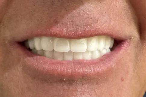 Case 4 All-on-4 / Full Arch — after treatment close-up