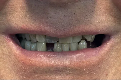 Case 4 All-on-4 / Full Arch — before treatment close-up