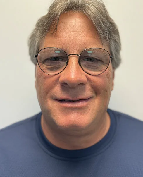 Case 4 All-on-4 / Full Arch — before treatment