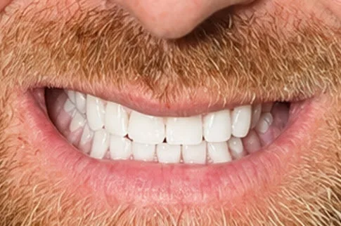 Case 3 Implant-Supported Dentures — after treatment close-up
