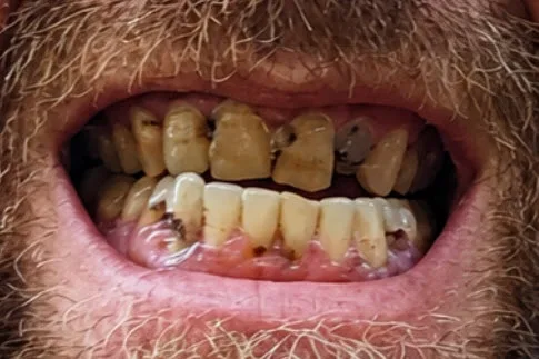 Case 3 Implant-Supported Dentures — before treatment close-up