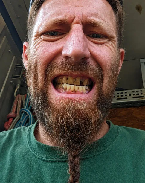 Case 3 Implant-Supported Dentures — before treatment