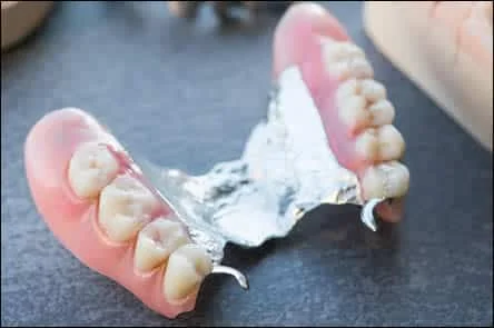 Cast partial denture with metal framework