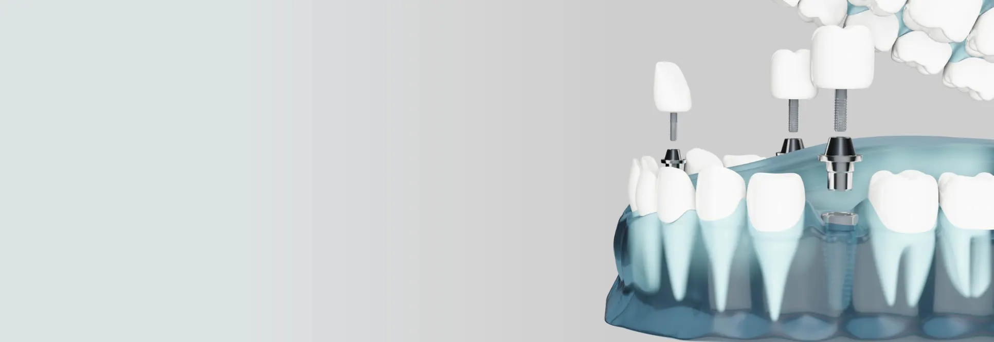 Computer guided dental implants at Detroit Dentist