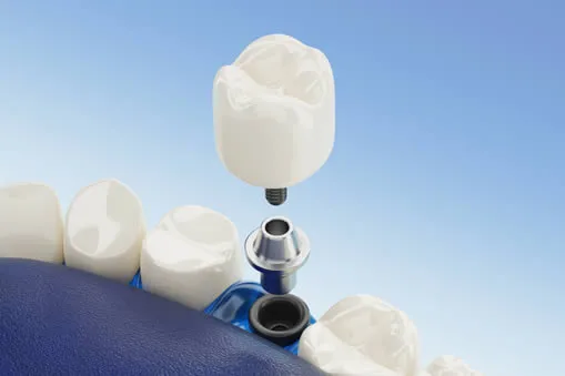 Experience Precision Implant Placement Like Never Before