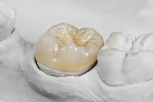 Is an Onlay Better Than a Dental Crown?