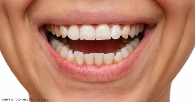 Porcelain veneers before treatment