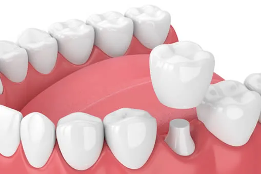 Dental crown materials illustration