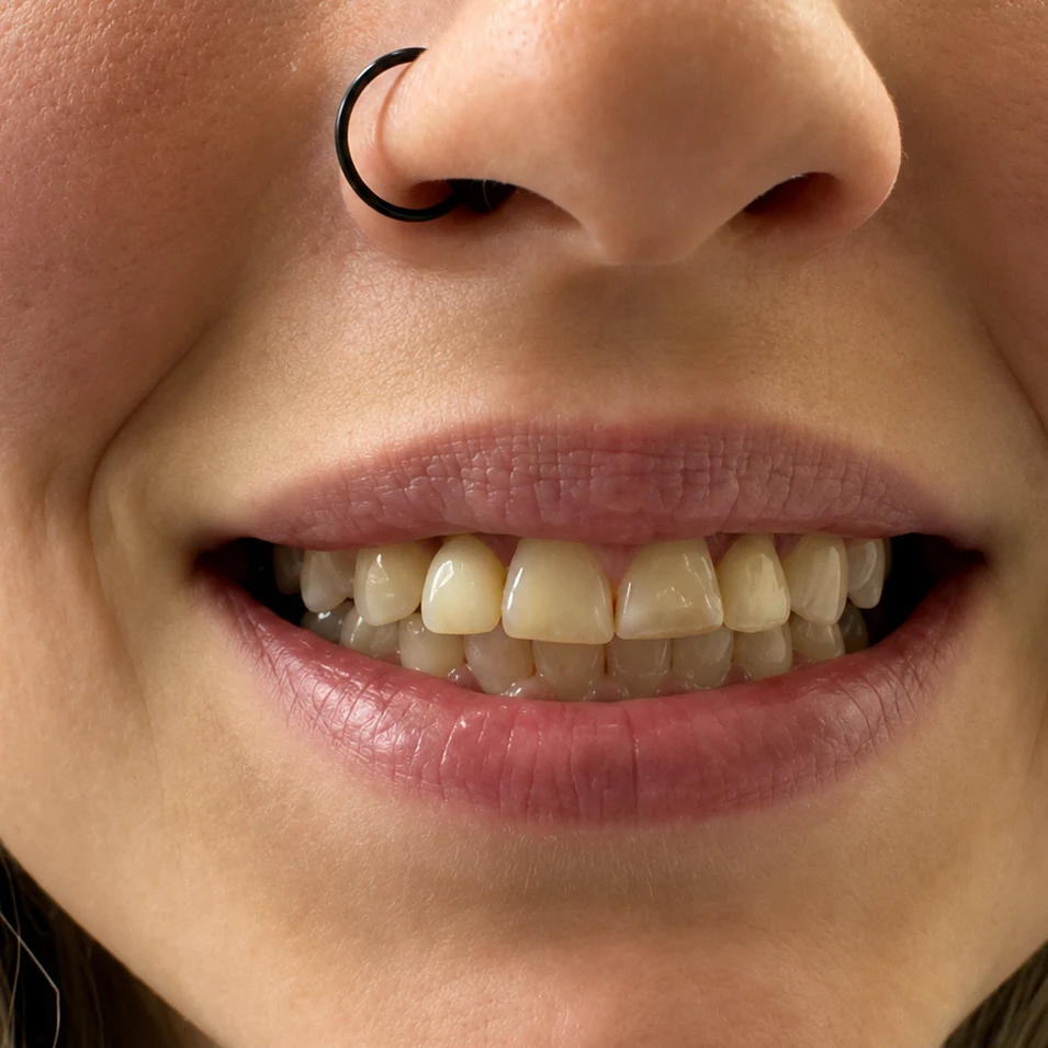 Close-up of a patient’s smile before crown restoration at Detroit Dentist