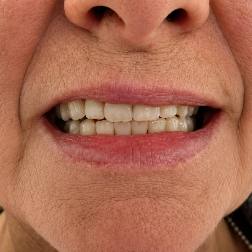 Close-up of a patient’s smile before All-on-4 full-arch implants at Detroit Dentist