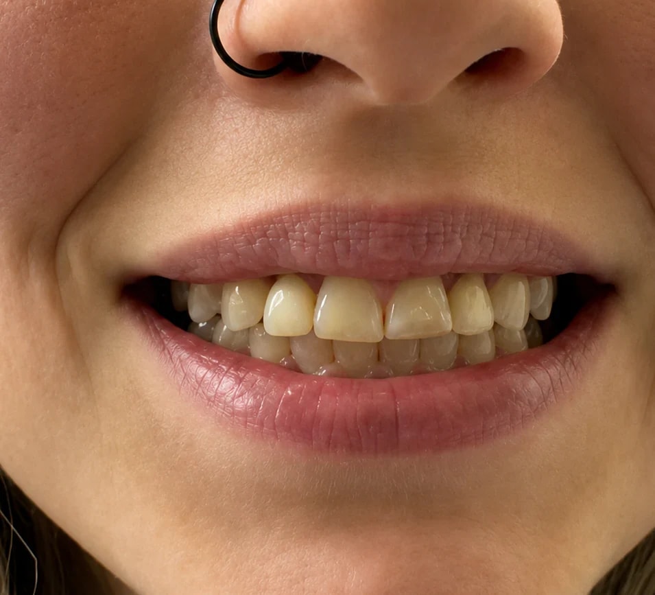 Case 1 Crowns & Veneers — before treatment