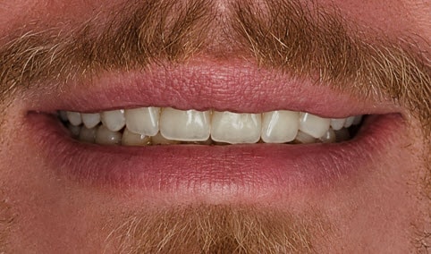 Case 7 All-on-4 / Full Arch — after treatment
