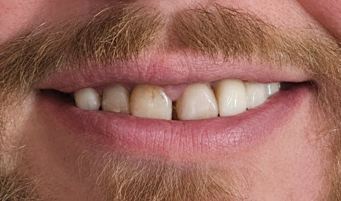 Case 7 All-on-4 / Full Arch — before treatment