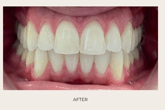 Case 8 Invisalign / Clear Aligners — after treatment