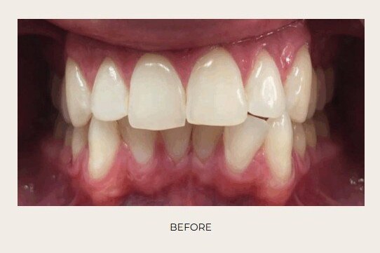 Case 8 Invisalign / Clear Aligners — before treatment