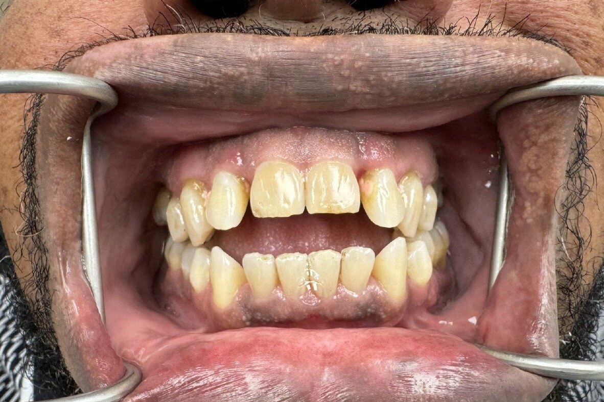 Case 9 Invisalign + Crown Work — before treatment