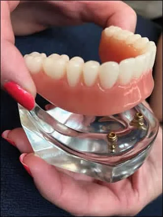 Snap-in-Fit complete denture