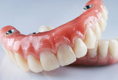 Full-arch zirconia implant bridge restoration