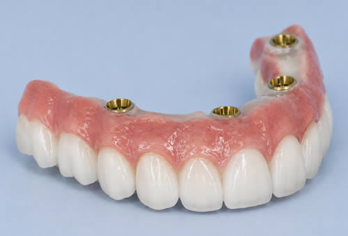 Snap-on implant denture with gold attachment housings