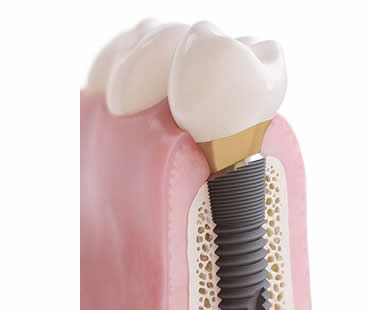 Choosing a Professional for Your Dental Implants in Birmingham