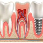 dental implant