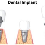 dentalimplant