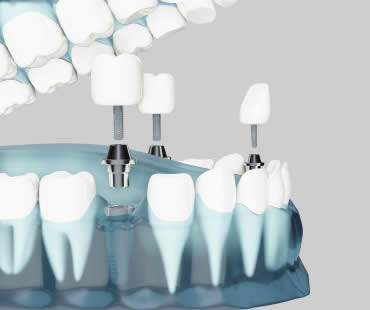 Dental Implants: Choosing the Best Implant Dentist in Bingham Farms